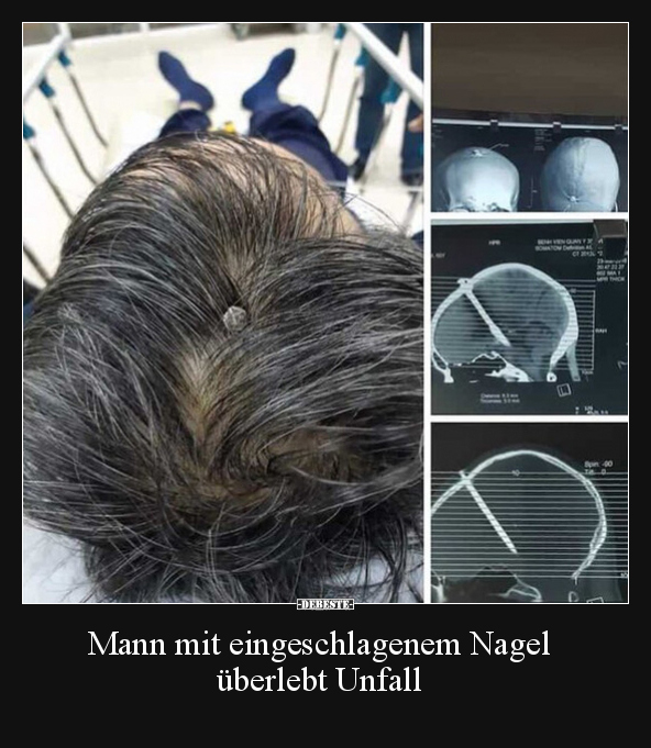 Mann mit eingeschlagenem Nagel überlebt Unfall.. - Lustige Bilder | DEBESTE.de