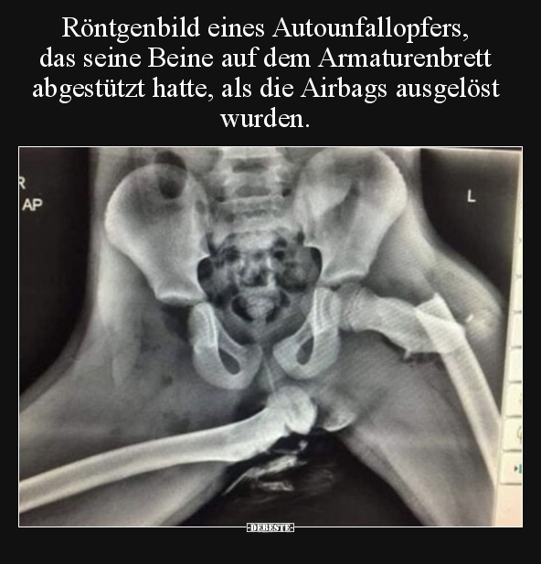 Röntgenbild eines Autounfallopfers, das seine Beine auf.. - Lustige Bilder | DEBESTE.de
