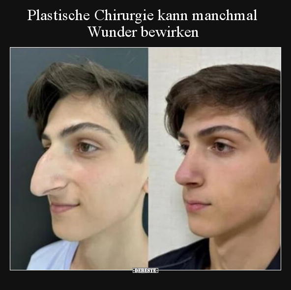 Plastische Chirurgie kann manchmal Wunder bewirken.. - Lustige Bilder | DEBESTE.de