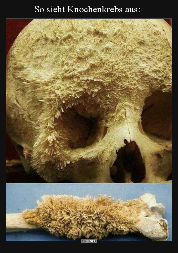 So sieht Knochenkrebs aus.. - Lustige Bilder | DEBESTE.de