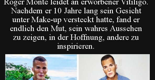 Roger Monte leidet an erworbener Vitiligo. Nachdem er 10.. Lustige