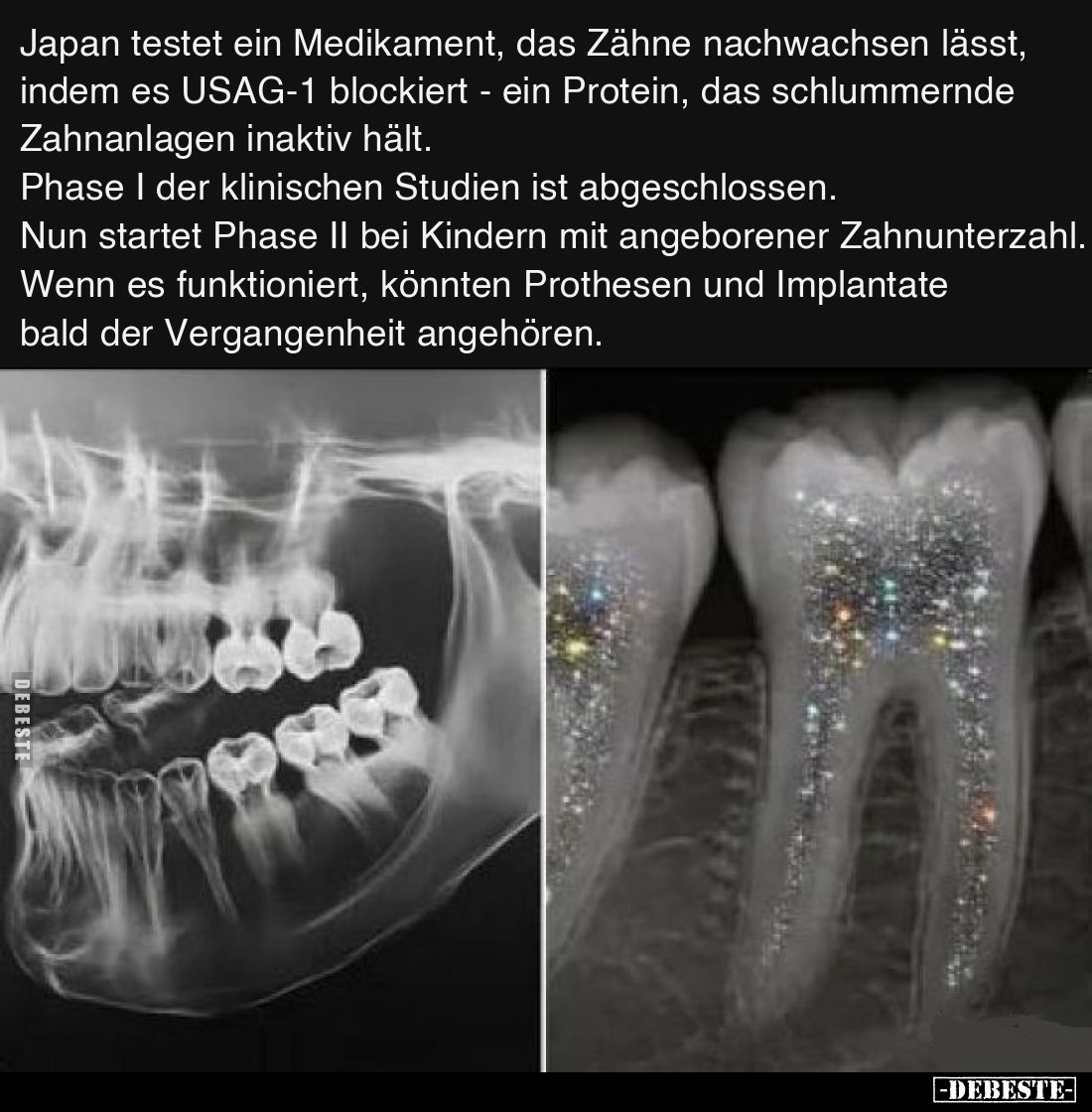 Japan testet ein Medikament, das Zähne nachwachsen lässt, indem es USAG-1 blockiert - ein Protein, das schlummernde Zahnanlag...