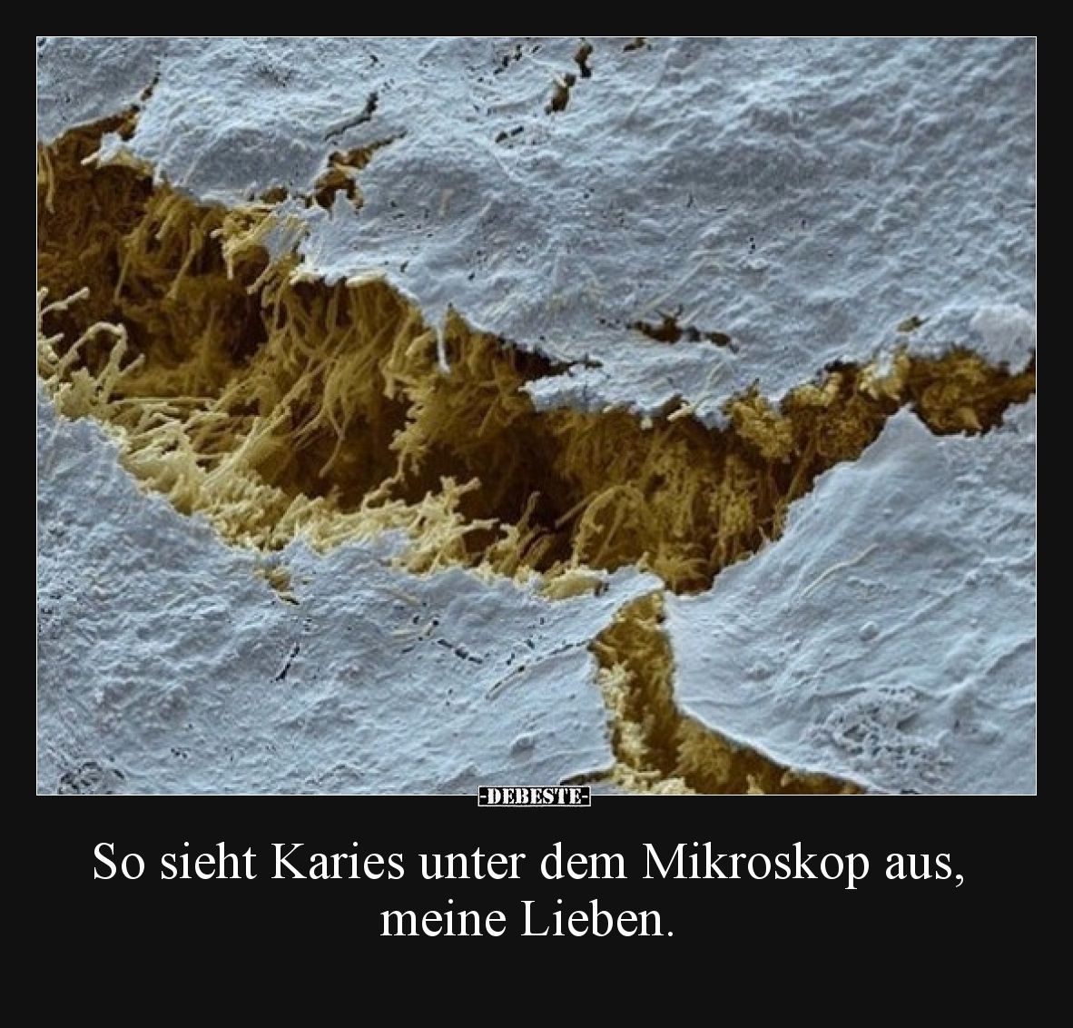 So sieht Karies unter dem Mikroskop aus, meine Lieben.