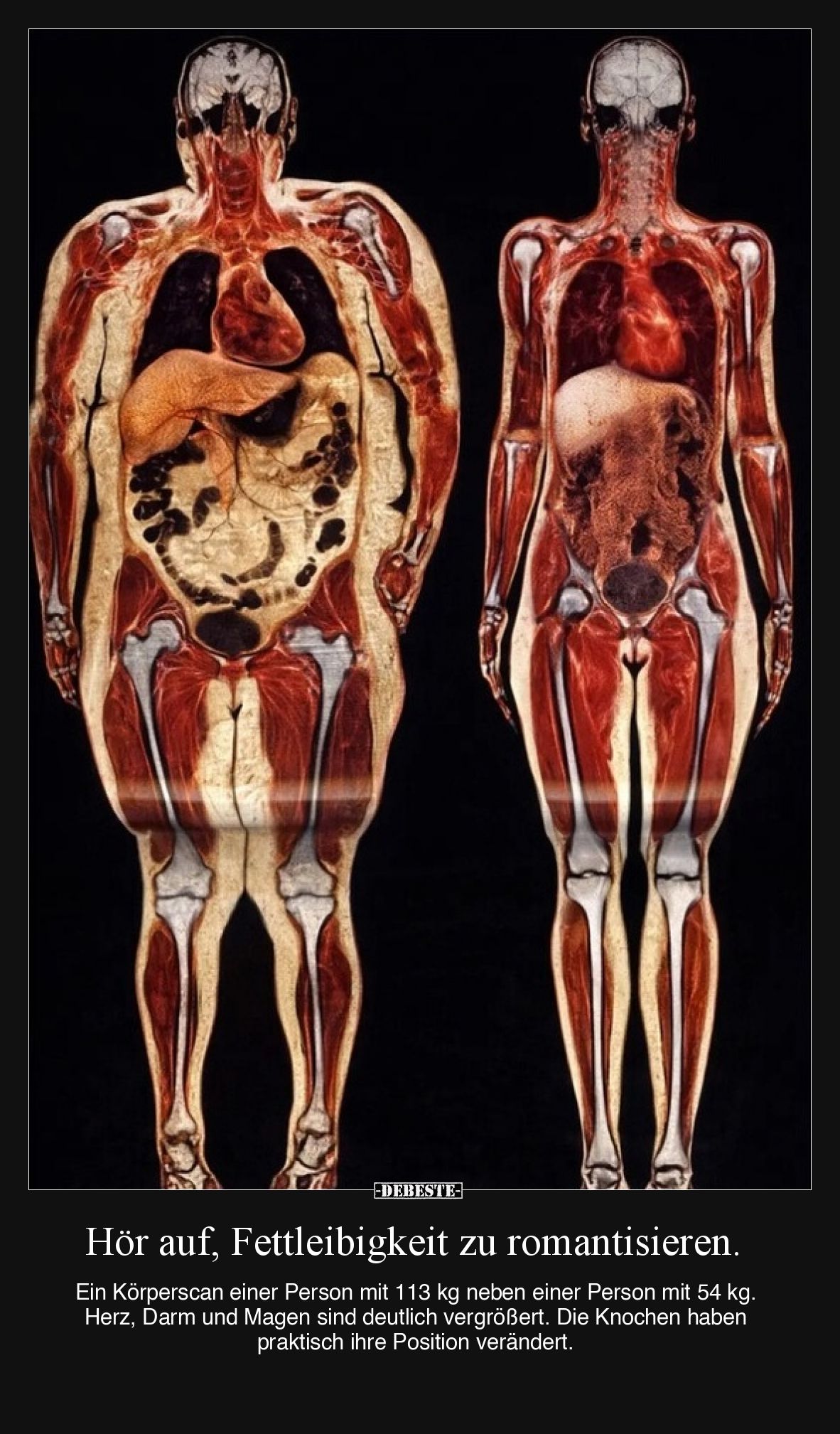 Hör auf, Fettleibigkeit zu romantisieren.  Ein Körperscan einer Person mit 113 kg neben einer Person mit 54 kg. Herz, Darm un...