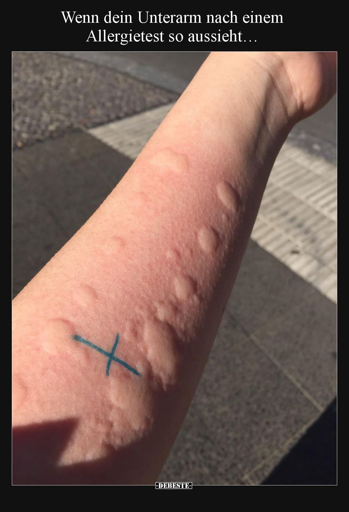 Wenn dein Unterarm nach einem Allergietest so aussieht…