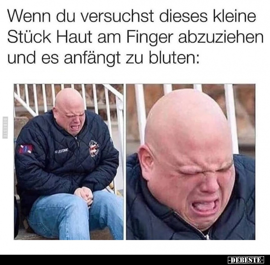Wenn du versuchst dieses kleine Stück Haut am Finger..