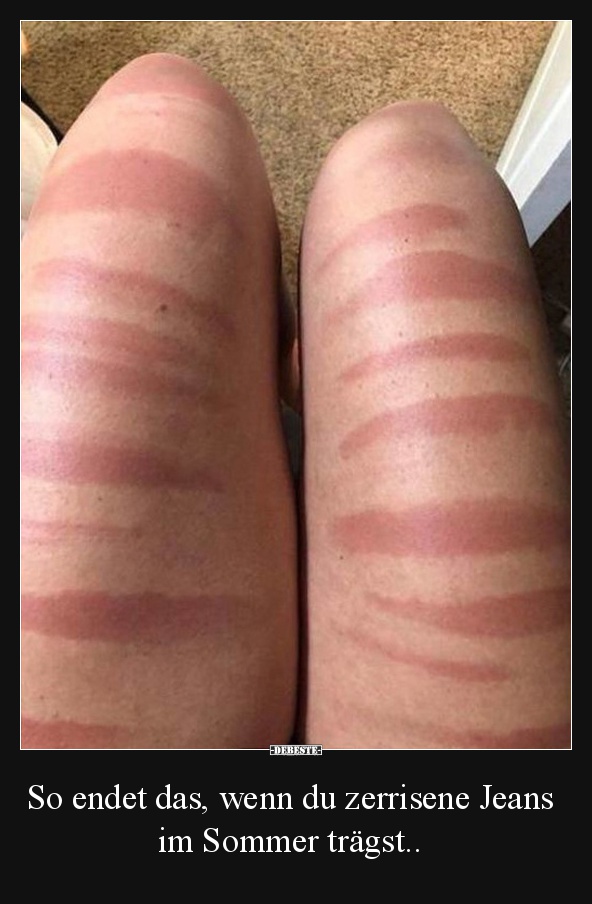 So endet das, wenn du zerrisene Jeans im Sommer trägst..
