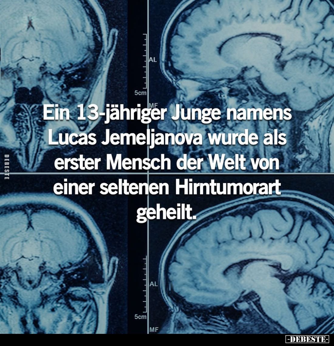 Ein 13-jähriger Junge namens Lucas Jemeljanova wurde als erster Mensch der Welt von einer seltenen Hirntumorart geheilt.