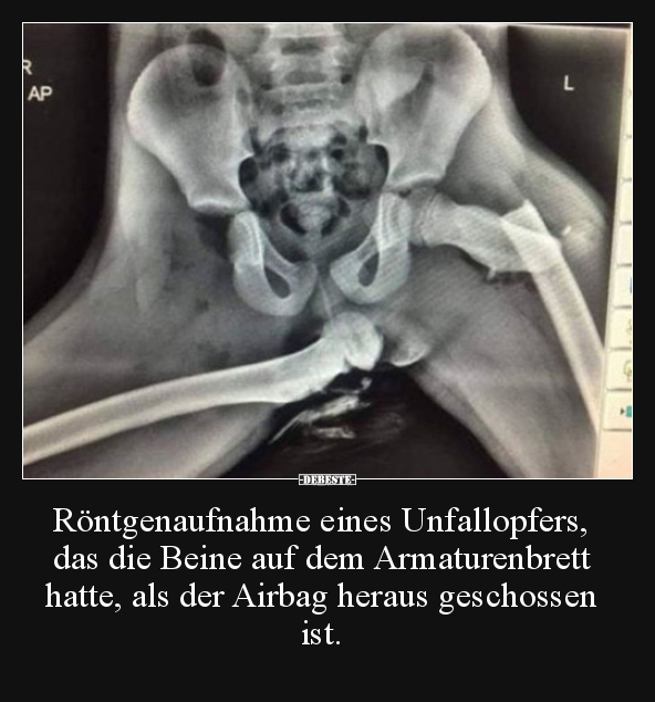 Röntgenaufnahme eines Unfallopfers, das die Beine auf dem.. - Lustige Bilder | DEBESTE.de