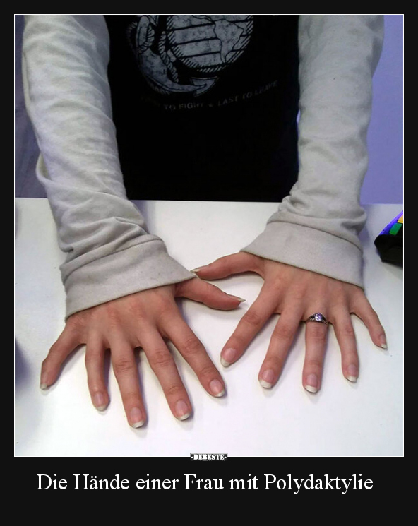 Die Hände einer Frau mit Polydaktylie.. - Lustige Bilder | DEBESTE.de