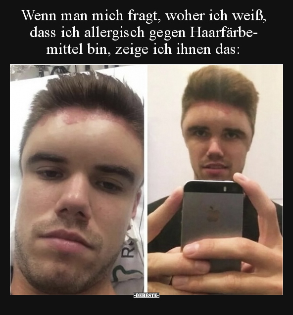 Wenn man mich fragt, woher ich weiß, dass ich allergisch gegen Haarfärbemittel bin, zeige ich ihnen das: