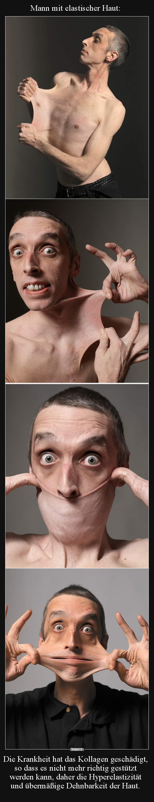 Mann mit elastischer Haut: Die Krankheit hat das Kollagen.. - Lustige Bilder | DEBESTE.de