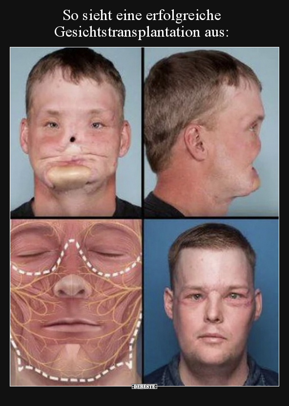 So sieht eine erfolgreiche Gesichtstransplantation.. - Lustige Bilder | DEBESTE.de