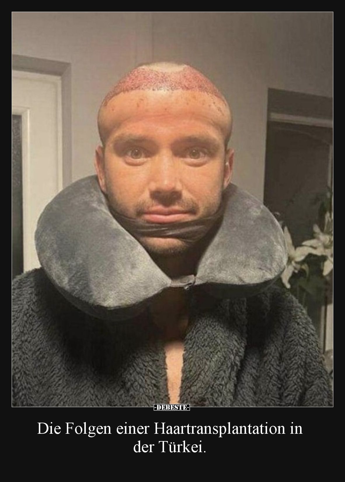 Die Folgen einer Haartransplantation in der Türkei.