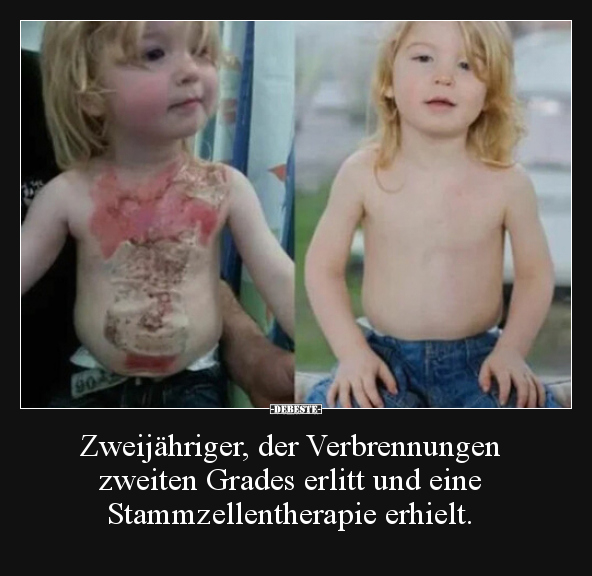 Zweijähriger, der Verbrennungen zweiten Grades erlitt und..