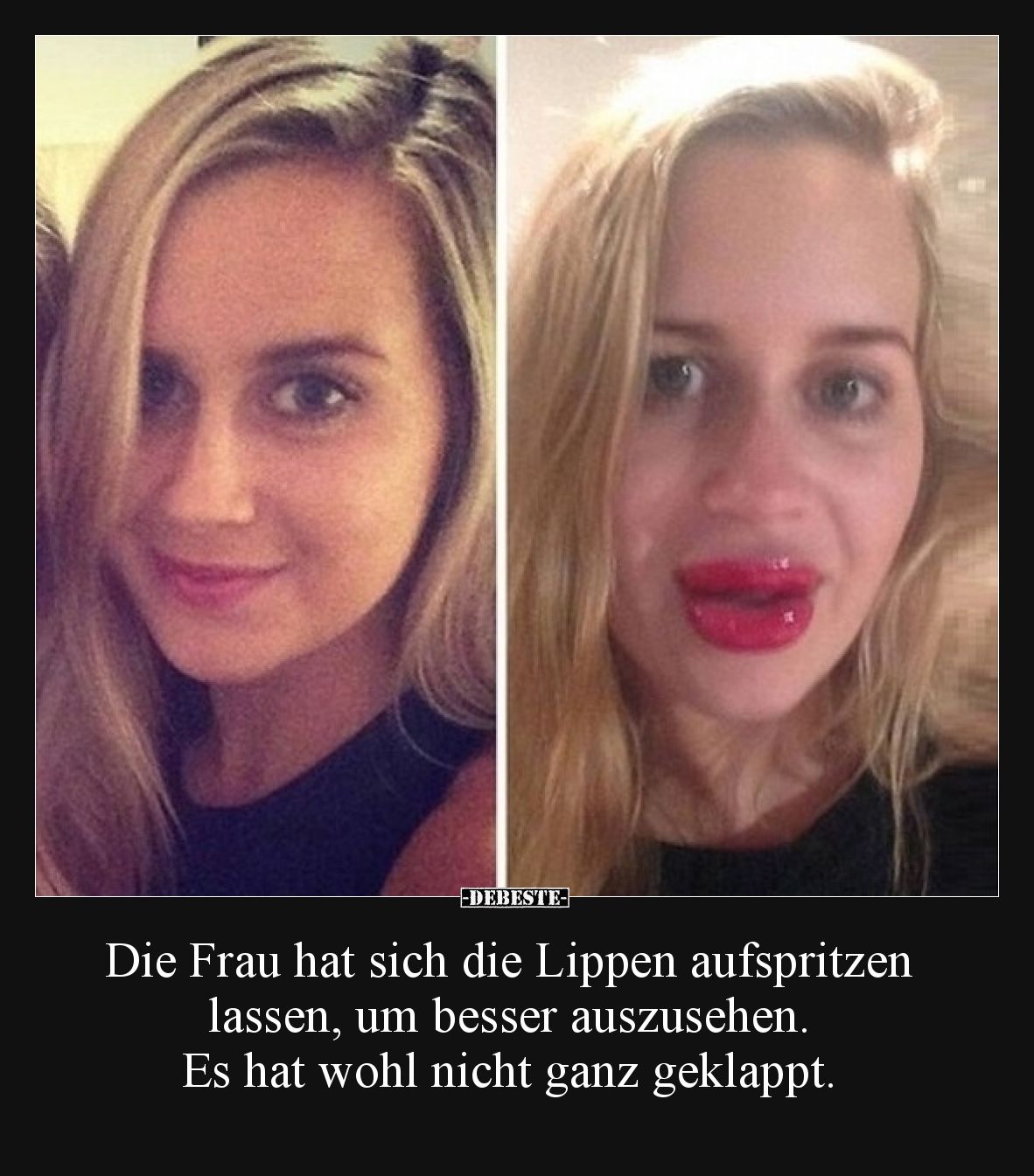 Die Frau hat sich die Lippen aufspritzen lassen, um besser auszusehen. Es hat wohl nicht ganz geklappt.