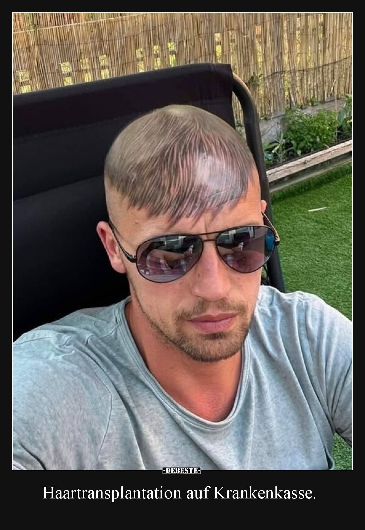 Haartransplantation auf Krankenkasse