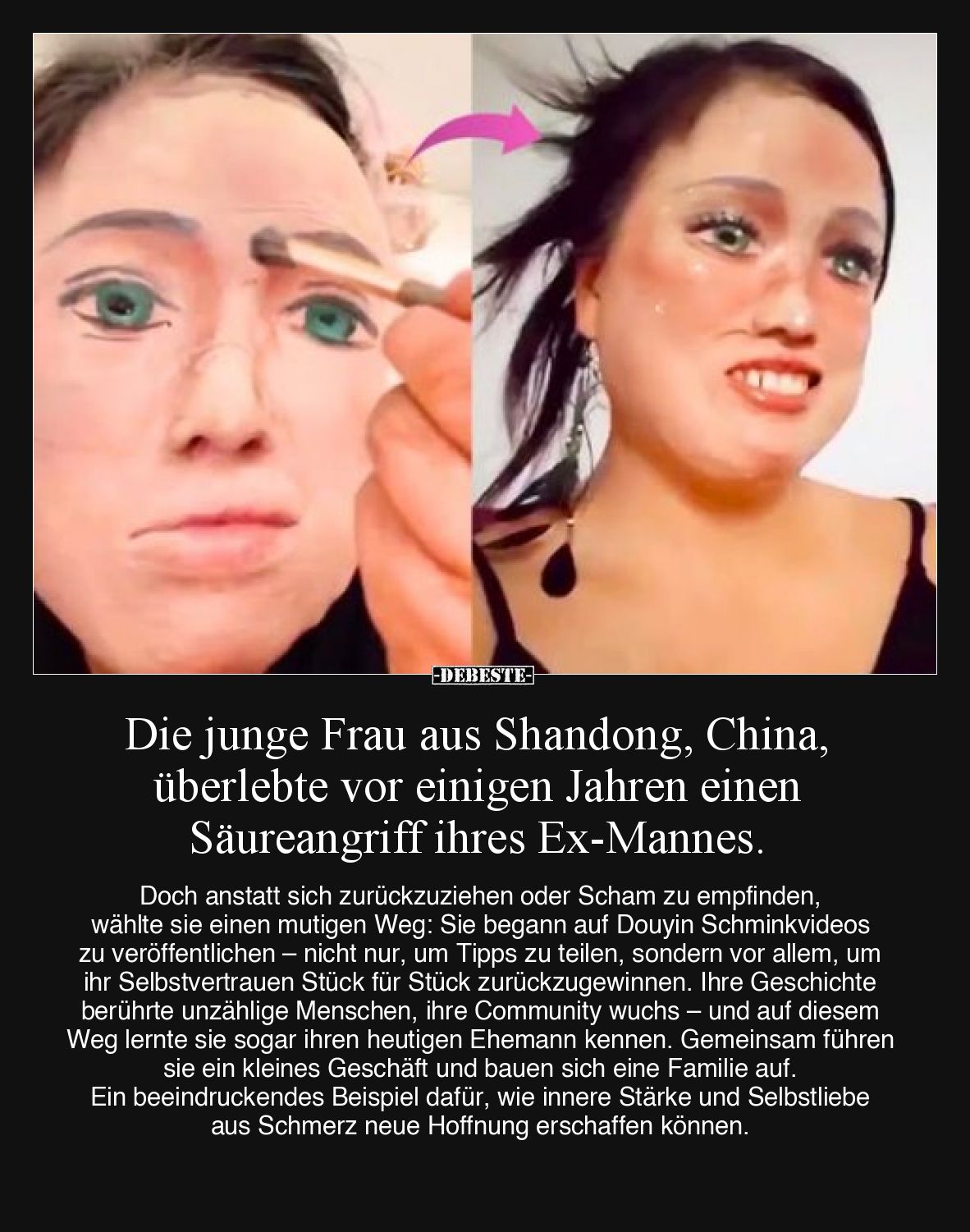 Die junge Frau aus Shandong, China, überlebte vor einigen Jahren einen Säureangriff ihres Ex-Mannes. Doch anstatt sich zurück...