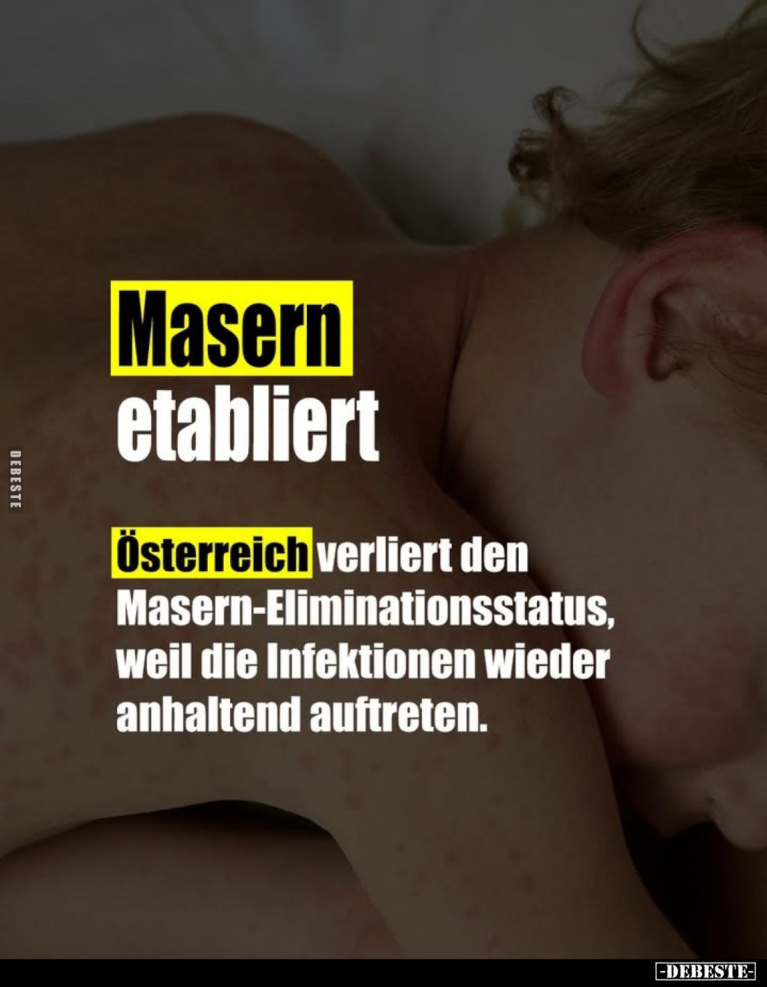 Masern etabliert.
Österreich verliert den Masern-Eliminationsstatus, weil die Infektionen wieder anhaltend auftreten.