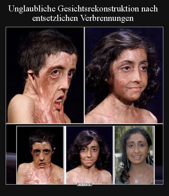 Unglaubliche Gesichtsrekonstruktion nach entsetzlichen.. - Lustige Bilder | DEBESTE.de