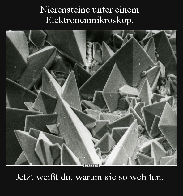 Nierensteine ​​unter einem Elektronenmikroskop.. - Lustige Bilder | DEBESTE.de