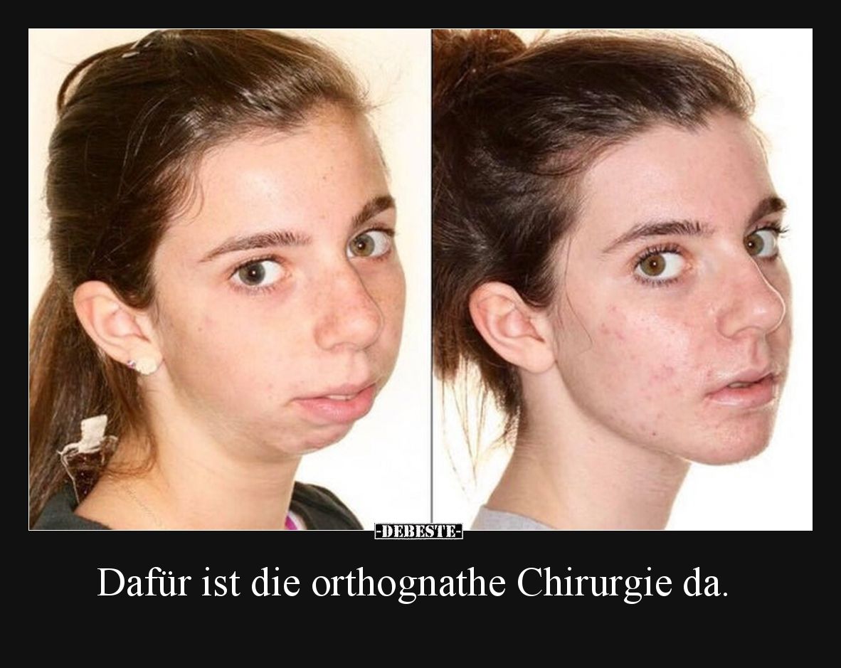 Dafür ist die orthognathe Chirurgie da.