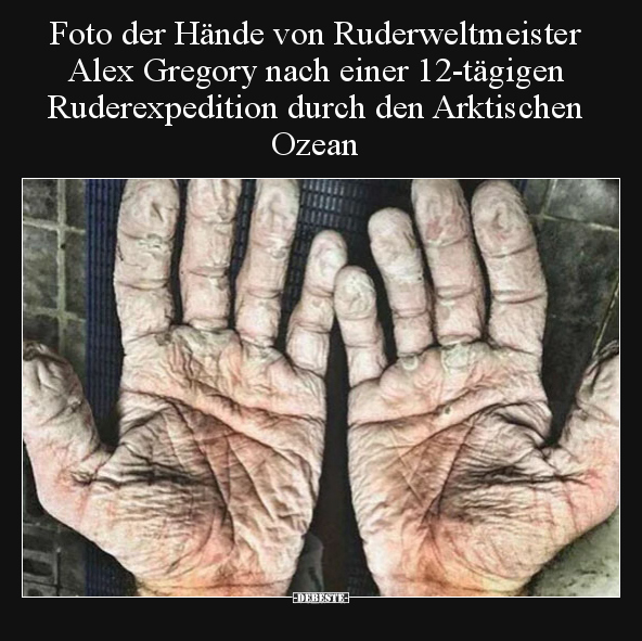 Foto der Hände von Ruderweltmeister Alex Gregory nach einer.. - Lustige Bilder | DEBESTE.de