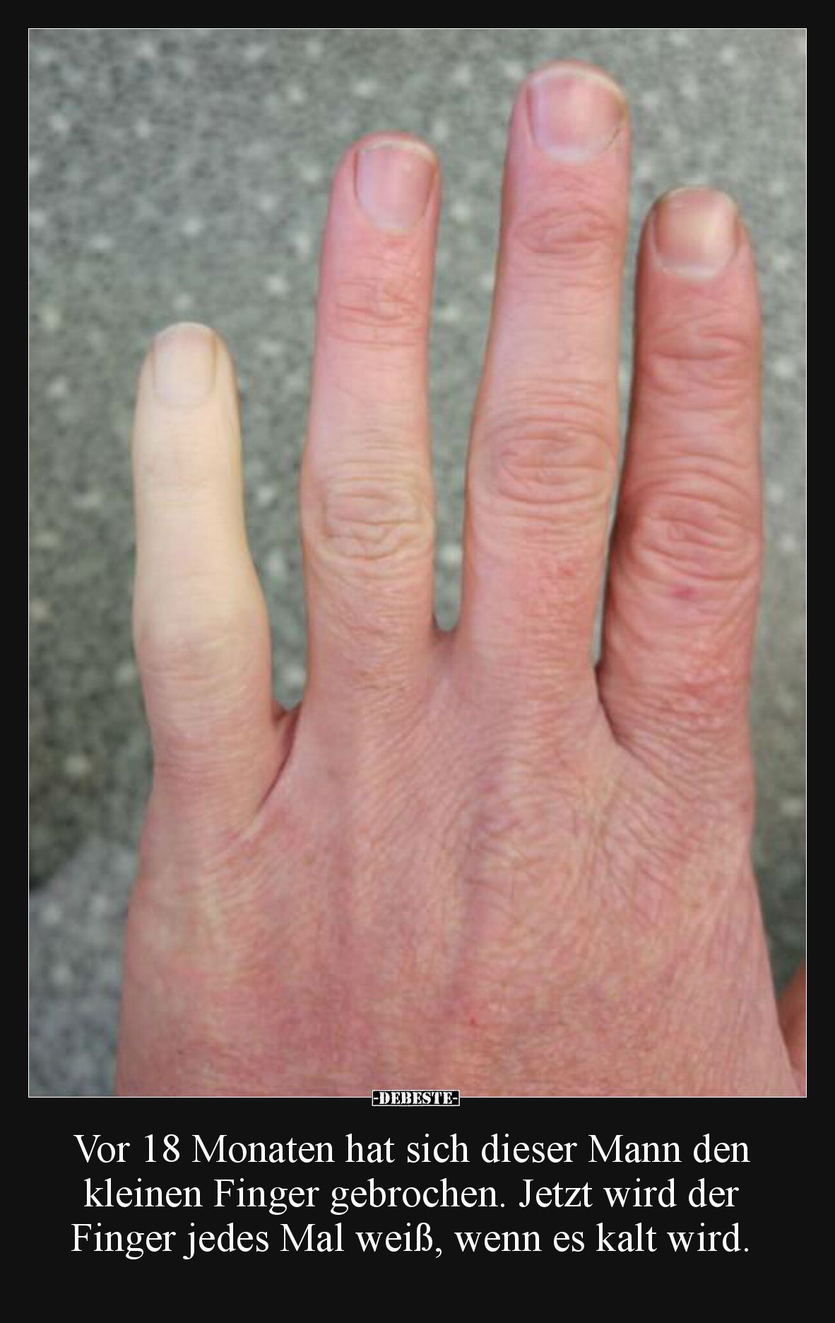 Vor 18 Monaten hat sich dieser Mann den kleinen Finger.. - Lustige Bilder | DEBESTE.de