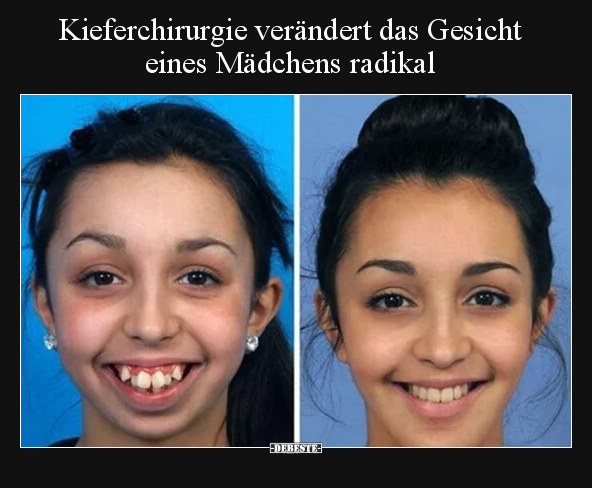 Kieferchirurgie verändert das Gesicht eines Mädchens.. - Lustige Bilder | DEBESTE.de