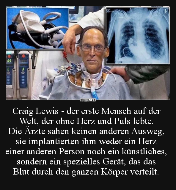 Craig Lewis - der erste Mensch auf der Welt, der ohne Herz.. - Lustige Bilder | DEBESTE.de