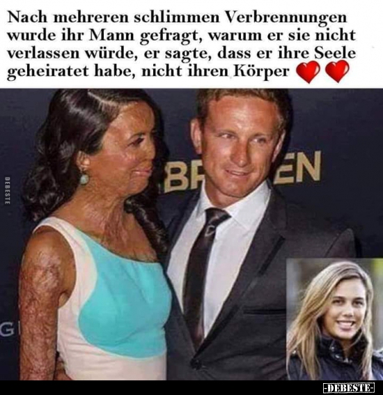 Nach mehreren schlimmen Verbrennungen wurde ihr Mann gefragt..