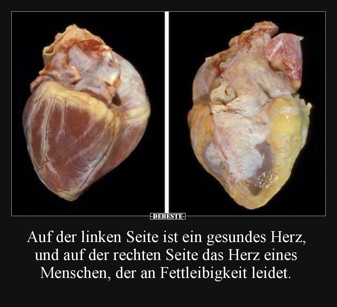 Auf der linken Seite ist ein gesundes Herz, und auf der rechten Seite das Herz eines Menschen, der an Fettleibigkeit leidet.
