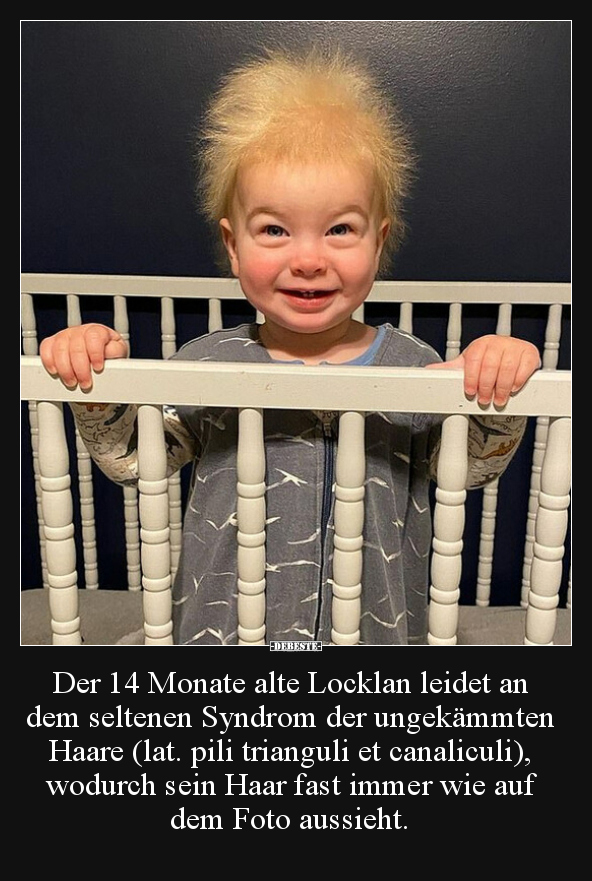 Der 14 Monate alte Locklan leidet an dem seltenen Syndrom der ungekämmten Haare (lat. pili trianguli et canaliculi), wodurch ...