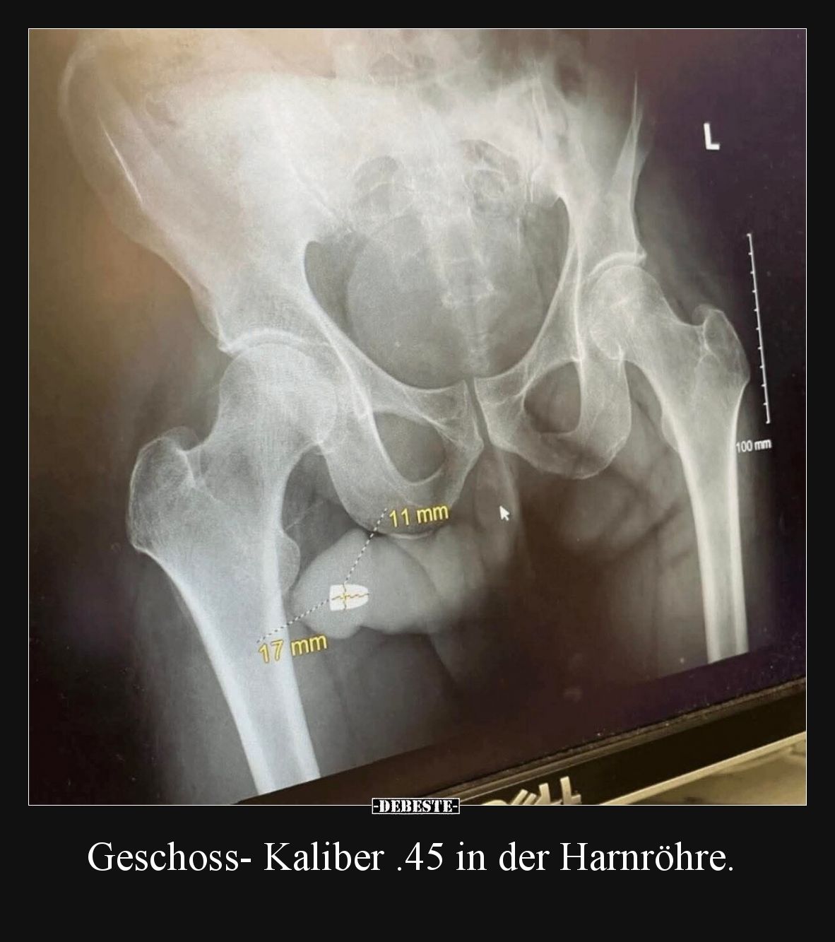 Geschoss- Kaliber .45 in der Harnröhre.
