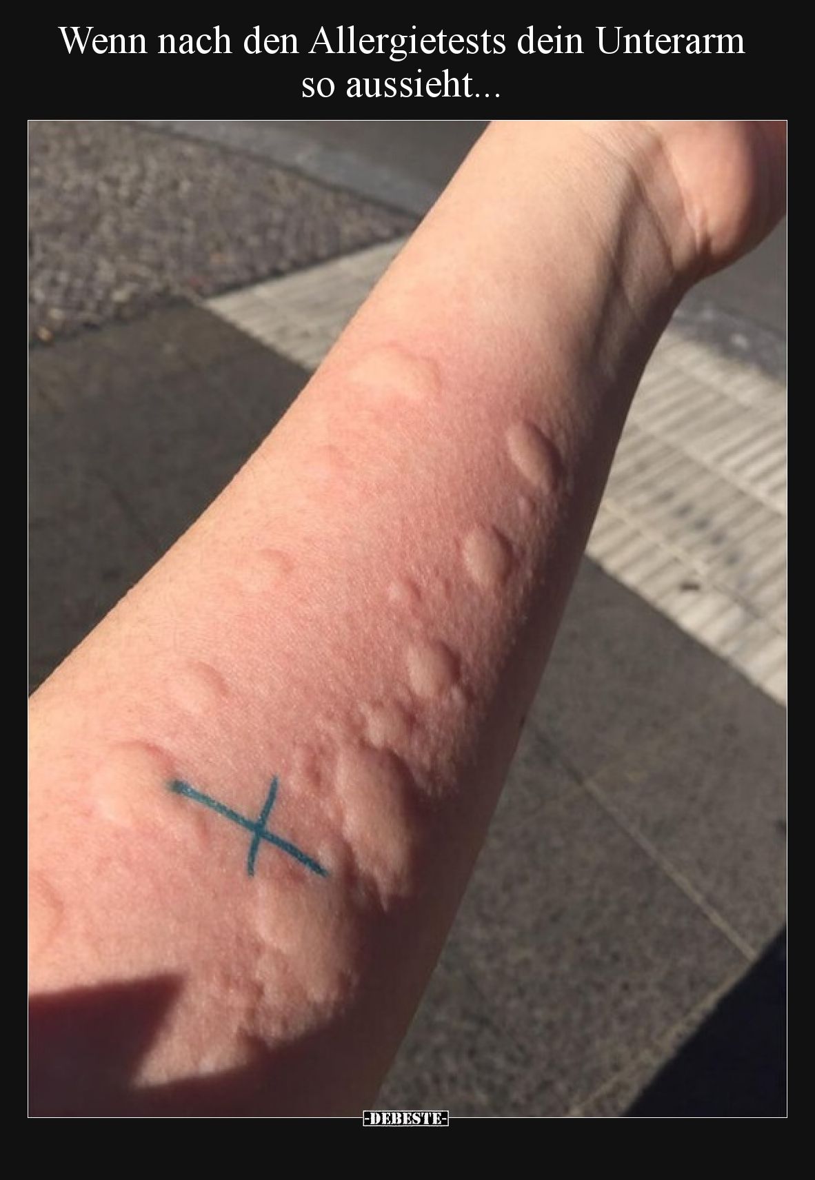 Wenn nach den Allergietests dein Unterarm so aussieht...