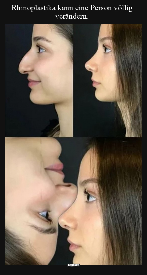 Rhinoplastika kann eine Person völlig verändern... - Lustige Bilder | DEBESTE.de