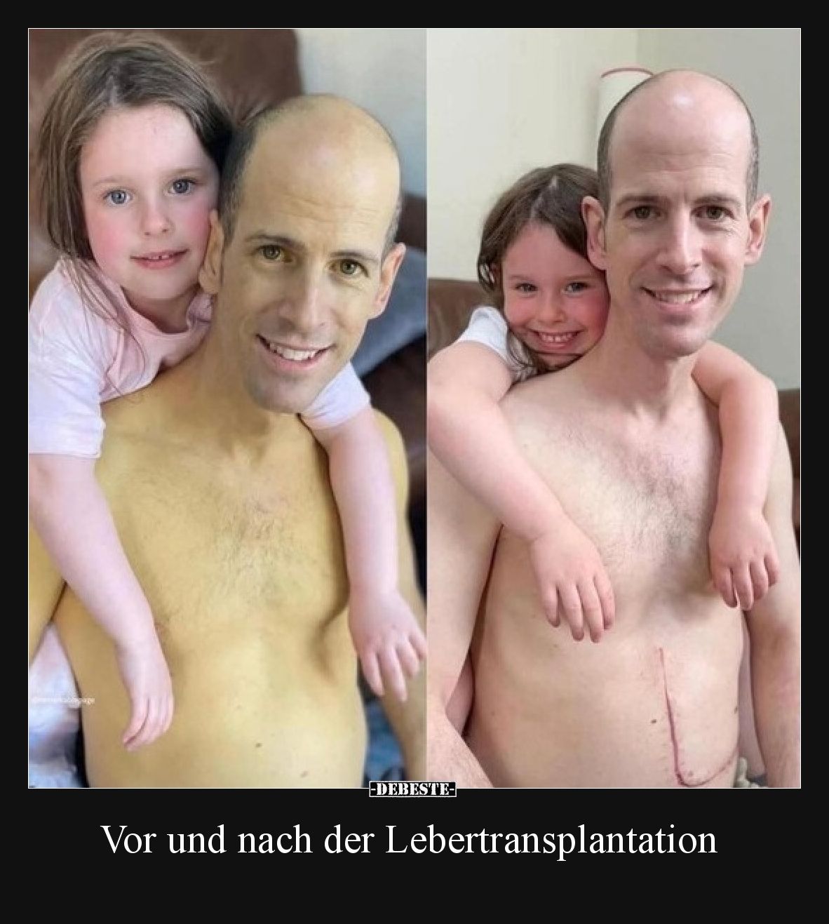 Vor und nach der Lebertransplantation