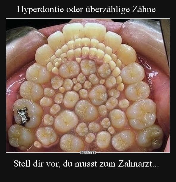 Hyperdontie oder überzählige Zähne..