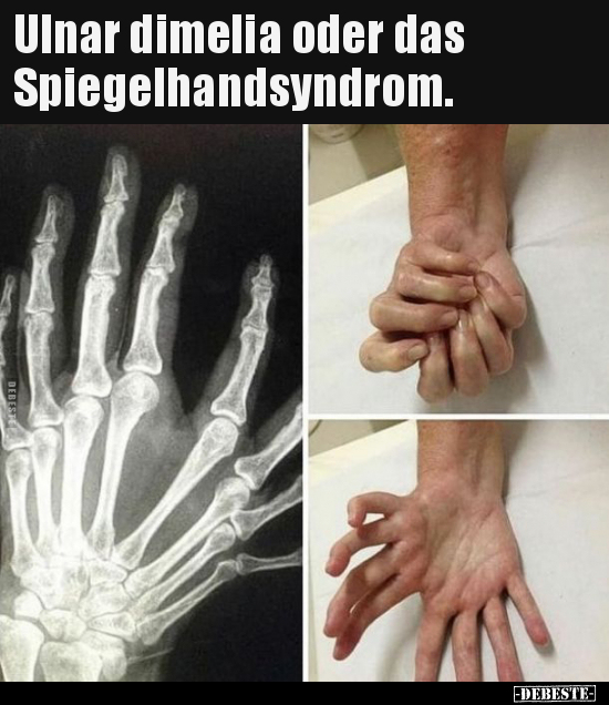 Ulnar dimelia oder das Spiegelhandsyndrom...