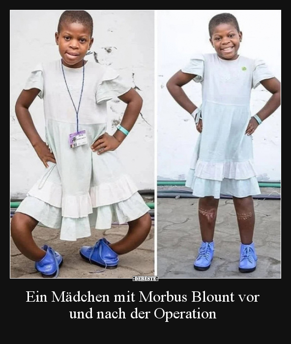Ein Mädchen mit Morbus Blount vor und nach der Operation.. - Lustige Bilder | DEBESTE.de