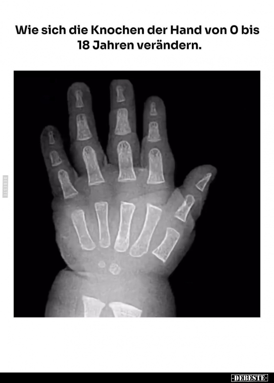 Wie sich die Knochen der Hand von O bis 18 Jahren verändern.. - Lustige Bilder | DEBESTE.de