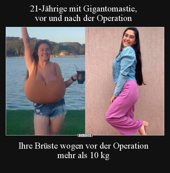 21-Jährige mit Gigantomastie, vor und nach der.. - Lustige Bilder | DEBESTE.de