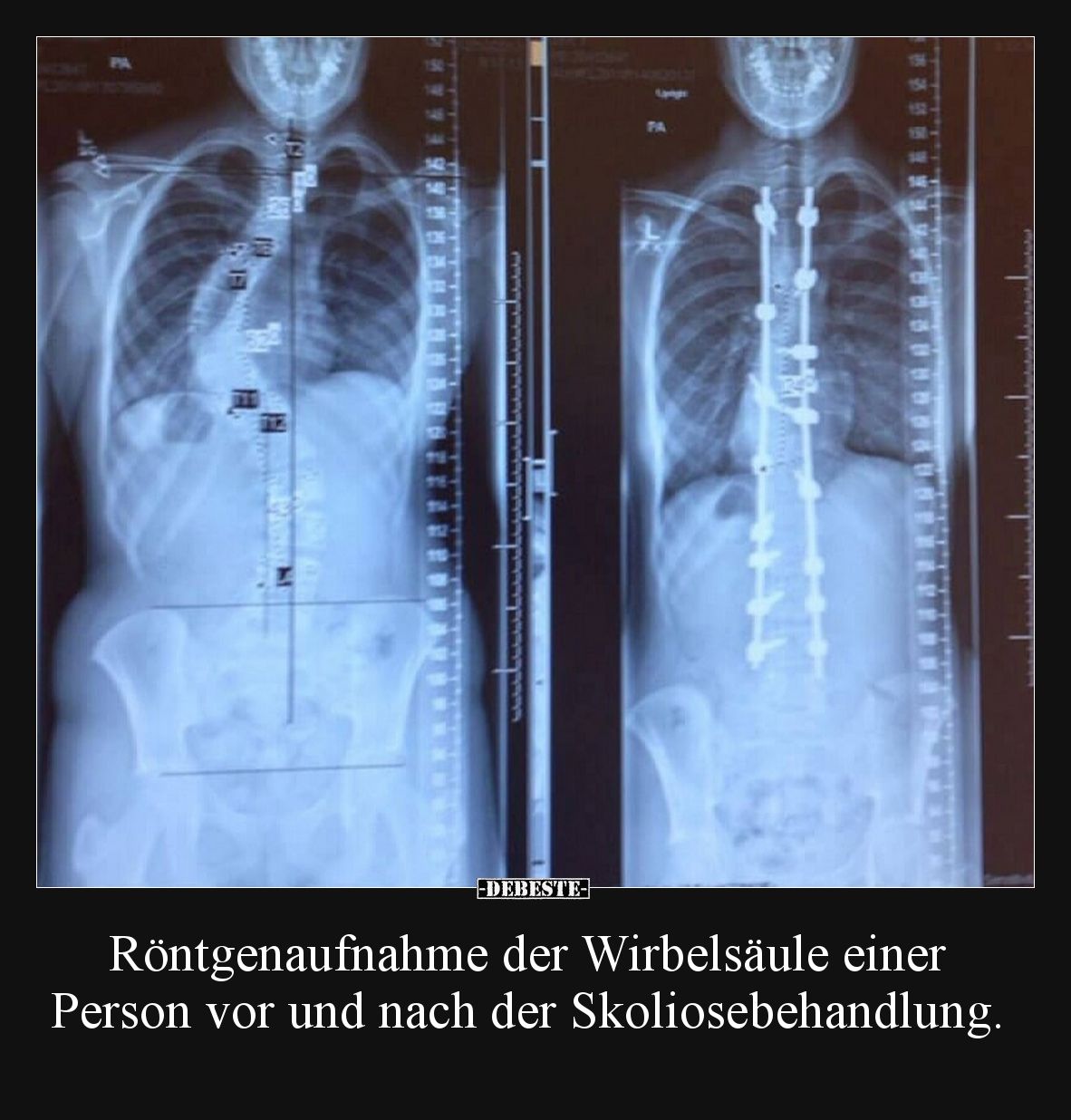Röntgenaufnahme der Wirbelsäule einer Person vor und nach.. - Lustige Bilder | DEBESTE.de