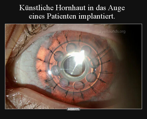 Künstliche Hornhaut in das Auge eines Patienten.. - Lustige Bilder | DEBESTE.de